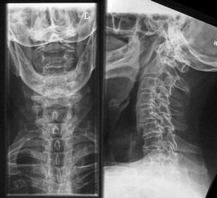 Ακτινογραφία της αυχενικής μοίρας της σπονδυλικής στήλης - μια μέθοδος για τη διάγνωση της οστεοχόνδρωσης